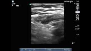 Ultrasound compression test for DVT Left Common Femoral Vein DVT present [upl. by Bradway]