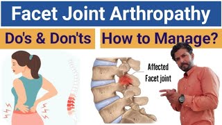 What is Facet Joint Syndrome Full Details  How to Manage Facet Joint Arthropathy [upl. by Otrevlig]