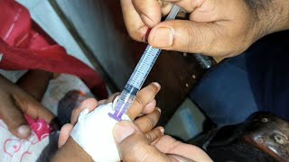 Child Meropenem 250mg amp Amikacin intravenous injection Video 24 Ep 71 Injection Tips [upl. by Biancha]