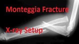 Monteggia Fracture Xray Setup [upl. by Hainahpez]