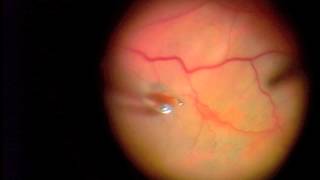 25 Gauge Vitrectomy for Macular Pucker ERM [upl. by Socram]