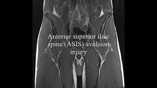 Anterior superior iliac spine avulsion [upl. by Feltie]