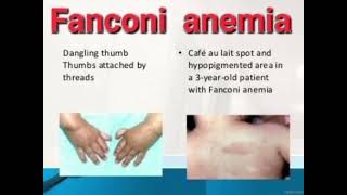 Fanconi anemia History mrcpch Clinical [upl. by Yelbmik936]