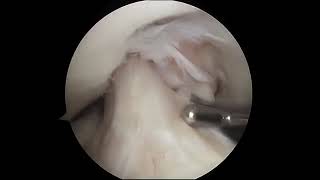 Torn Meniscus Arthroscopic Surgery [upl. by Neram]