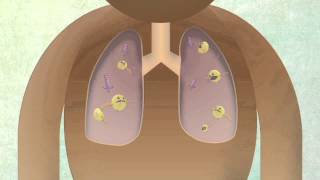 How The Body Reacts To Tuberculosis [upl. by Yalahs]