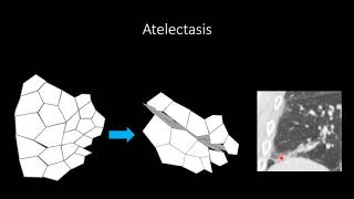 Atelectasis [upl. by Marko158]