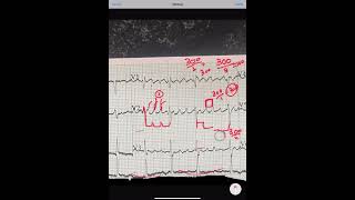 ECG  ATRIAL FLUTTER [upl. by Nnahtur]