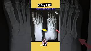 Fracture 5th Metatarsal  Xray Foot shorts xray [upl. by Marguerita]