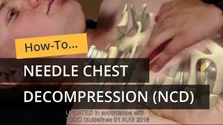 Needle Chest Decompression in TCCC [upl. by Rusell]