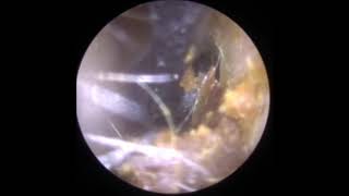 Gentle ear wax removal with Jobson Horne Probe [upl. by Nnauol]