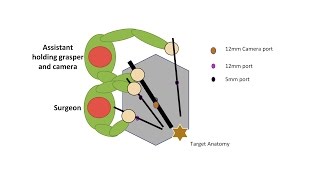 Learning Laparoscopic Sigmoid Colectomy High Anterior Resection [upl. by Akcirederf]