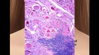 Anaplastic thyroid cancer pictures [upl. by Dorolisa824]