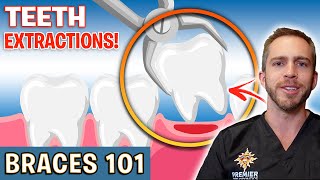 BRACES 101 Tooth Extractions For Braces  Treatment Minute Talk [upl. by Aihsyn]