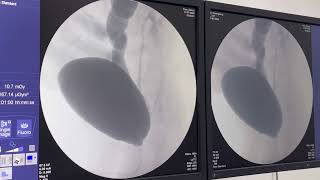 Uretrocistografia retrógrada miccional UCM em paciente com Refluxo vésico ureteral [upl. by Wes159]