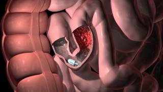 PillCam SB 3 Animation  GI Tract Abnormalities [upl. by Ennail]