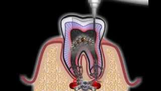 Wurzelbehandlung beim Zahnarzt [upl. by Nauj]
