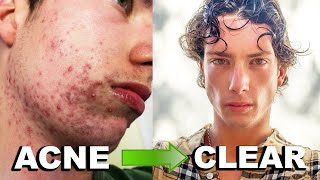 MY ACCUTANE JOURNEY  Clearing 6 Years of Acne Big Acne Transformation [upl. by Helbona44]