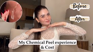 Chemical Peel Final Results😍  Cost amp Experience  Shilpa Chaudhary [upl. by Oregolac609]