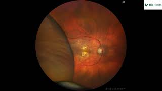 Peripheral Exudative Chorioretinopathy PECR transient choroidal mass Alex Weppelmann  2023 03 10 [upl. by Maghutte86]