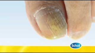 Fungal Nail Condition by Scholl [upl. by Atlanta]