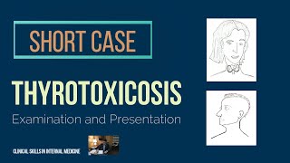 Thyrotoxicosis  Short Case [upl. by Camellia]