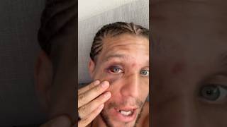 🙏👁️ BRIAN ORTEGA REACTS AND GIVES A HEALTH UPDATE AFTER LOSS TO DIEGO LOPES AT NOCHE UFC [upl. by Icram]