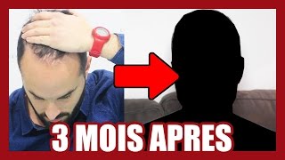 CALVITIE  MA GREFFE DE CHEVEUX  3 MOIS APRÈS [upl. by Abdul]