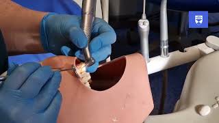 Traumatic dental injuries Splint removal procedures [upl. by Ani]