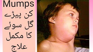 Mumps  Homeo treatment  By DrSohail Janjua [upl. by Hammock880]