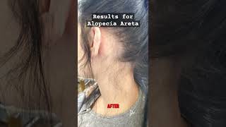 Alopecia Areata Treatment Houston Trichologist alopecia hairloss [upl. by Eldwun683]