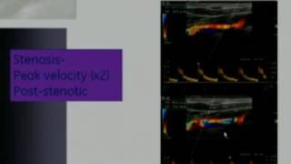 Carotid Doppler Protocol and Top Tips [upl. by Anilehcim]