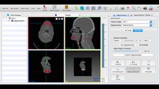 MITK Region Growing 3D Tutorial Video for Mandibular  Lower Jawbone Segmentation [upl. by Ecila]