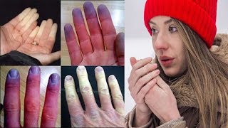 Raynauds Disease  phenomenon Tips and Proven Natural Cures [upl. by Renato574]