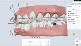 Archform auto align software for orthodontic aligners [upl. by Aimil]