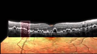 SPECTRALIS  Simultaneous Imaging [upl. by Encratis]