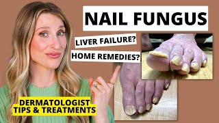 Dermatologist Shares Treatments for Nail Fungus amp Prevention Tips  Dr Sam Ellis [upl. by Ardnaxela]