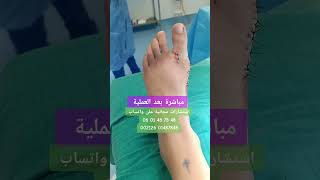 Chirurgie de lhallux valgus [upl. by Theis]