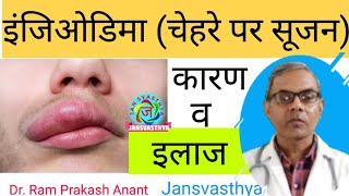 एंजिओडिमा का इलाज Treatment of Angioedema [upl. by Willock]