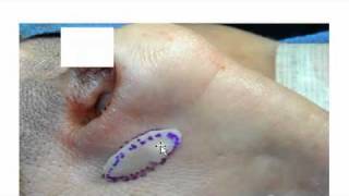 Nasal Valve Surgery – Functional Rhinoplasty in San Francisco – Dr David Kim [upl. by Sinegold217]