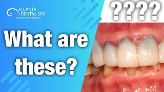 What are the black lines on gums Explained [upl. by Weiler]