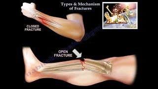 Types amp Mechanism Of Fractures  Everything You Need To Know  Dr Nabil Ebraheim [upl. by Hyps]