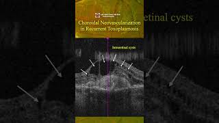 Choroidal neovascularization in recurrent toxoplasmosis [upl. by Lionello]