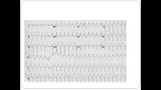 Fascicular VT  Dr Akif Baig [upl. by Adon]