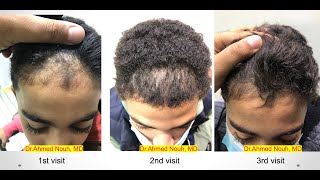 Frontal hair line disorders part 2 [upl. by Franek]