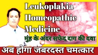 leukoplakia treatment in homeopathy in hindi  मुह के अन्दर सफेद दाग का इलाज ।DrAmitkrDubey [upl. by Yrailih49]