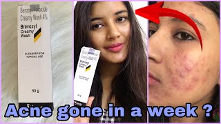 Brevoxyl Cream FaceWash for Rs 139 Review  Benzoyl Peroxide Creamy Wash Review  Somi Singh [upl. by Fillender]