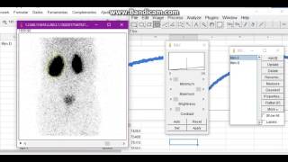 Cintilografia Renal DTPATC99m [upl. by Jephthah279]