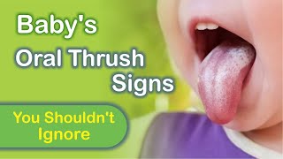 Oral Thrush in Babies Causes Symptoms and Treatment [upl. by Laveen]