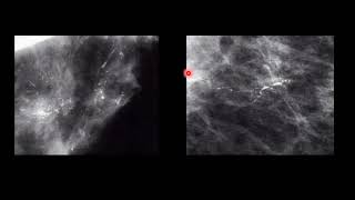 mamographic evaluation of breast calcifications part I [upl. by Kristi]