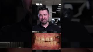 Opening vertical dimension of occlusion why proper treatment planning is important bruxism [upl. by Notnek]